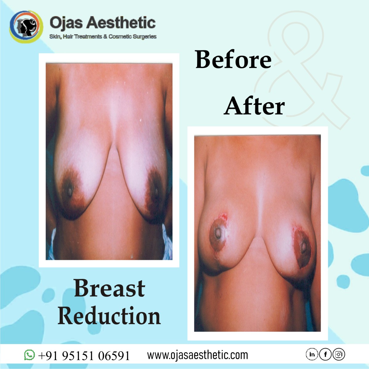 Breast reduction in Hyderabad