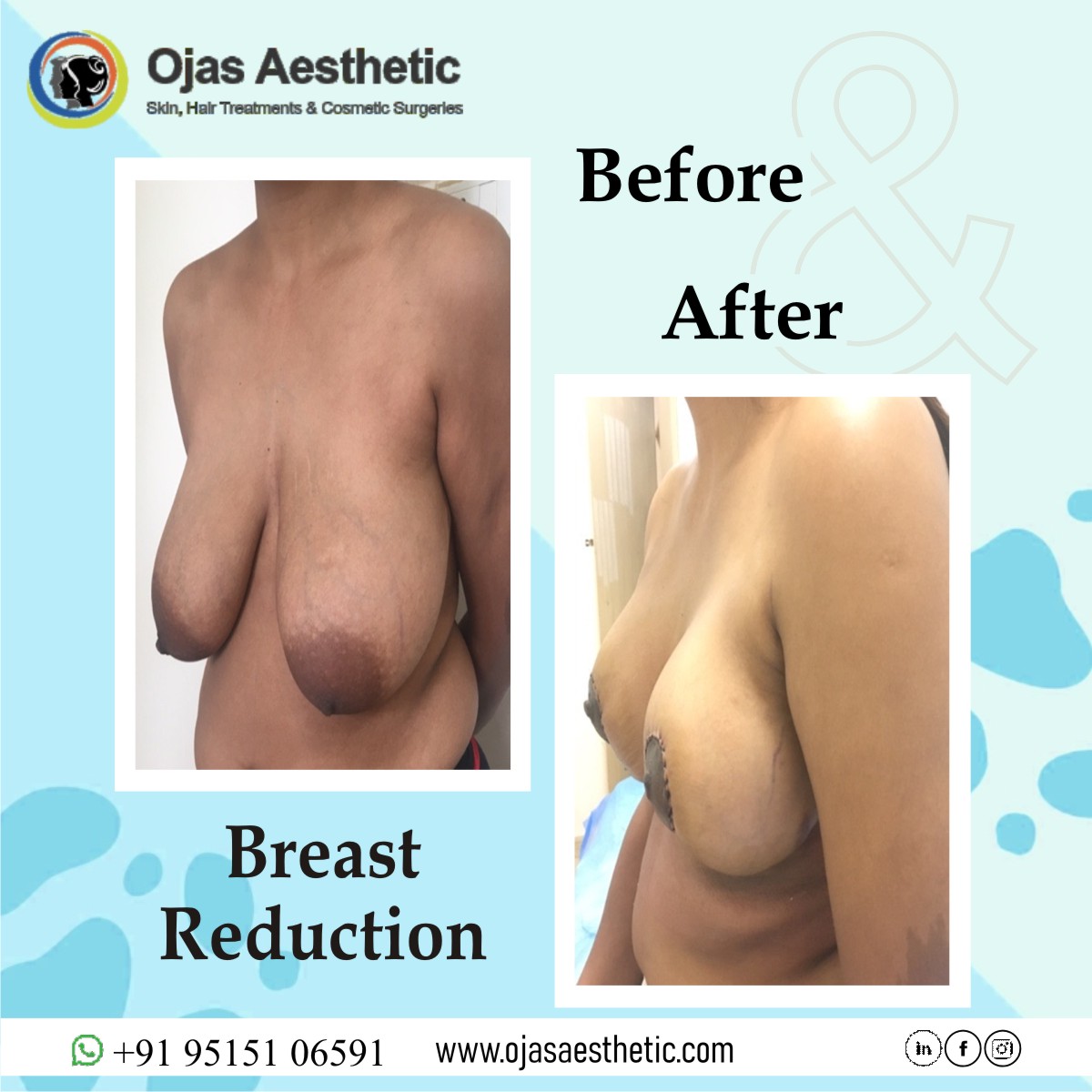 Breast reduction in Hyderabad