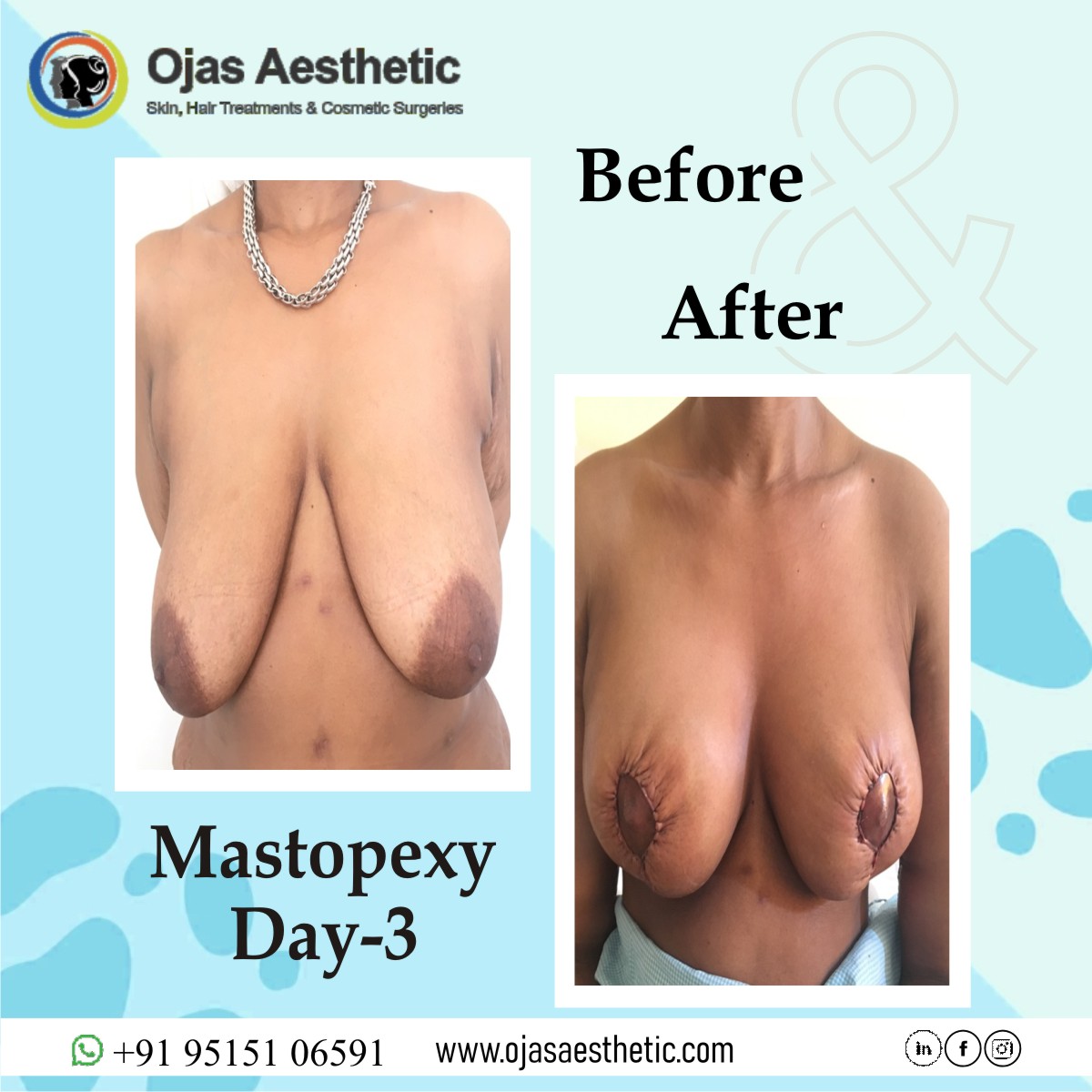 Breast reconstruction surgery in Hyderabad