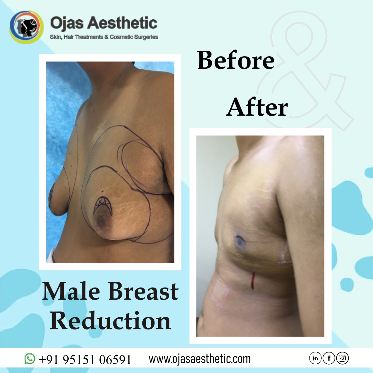 Male breast reduction In Madhapur