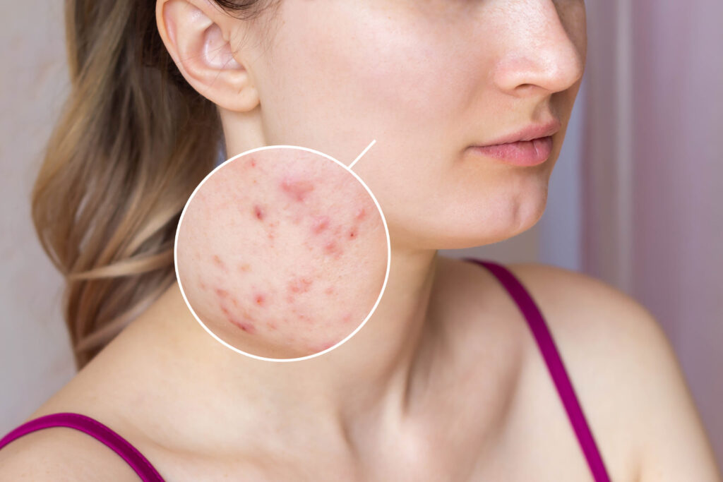 Best skin treatment in hyderbad