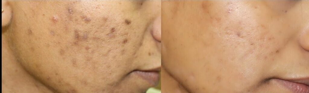 best skin treatment in Hyderabad