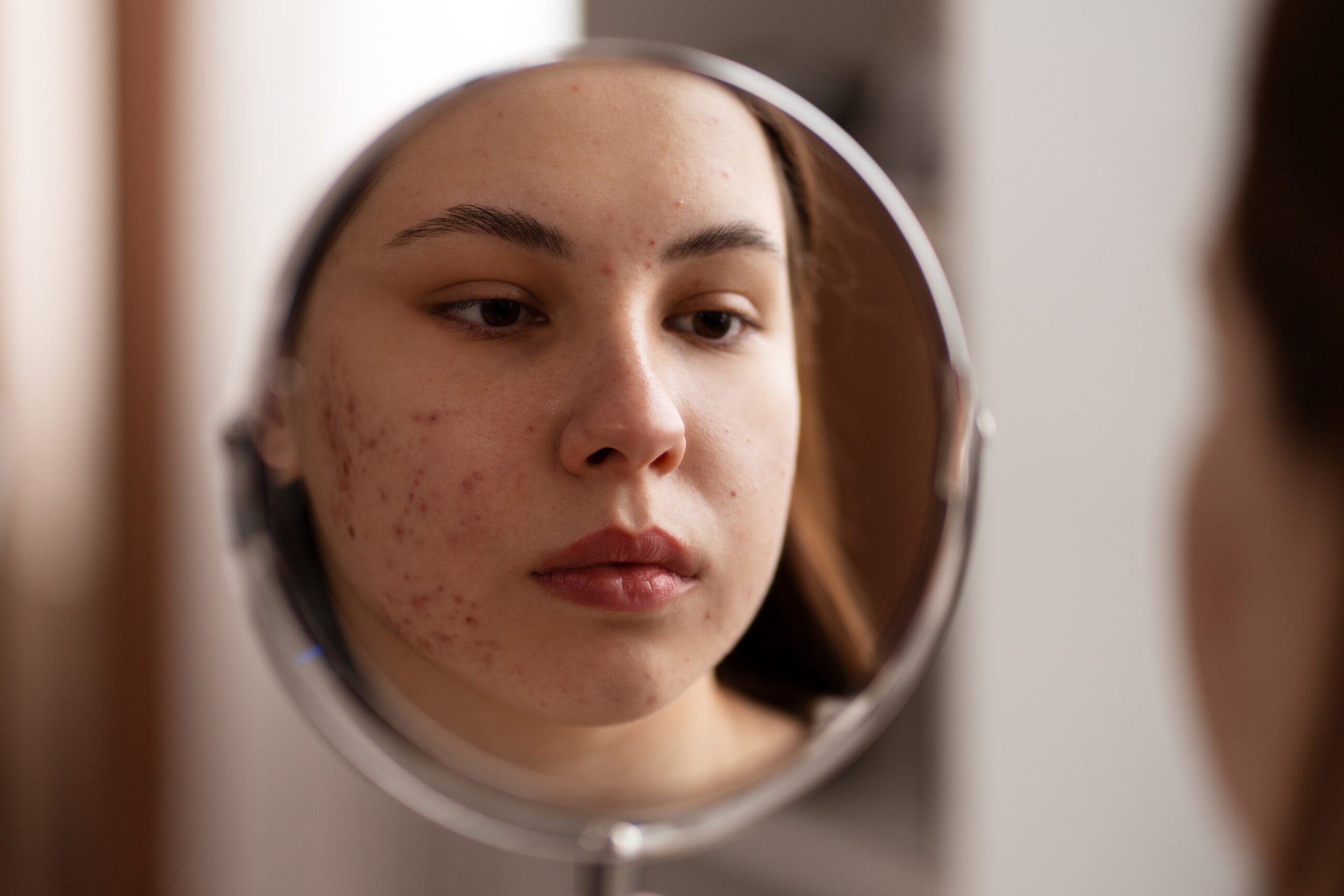 best skin treatment in Hyderabad