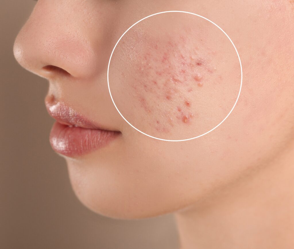 best acne treatment in hyderabad