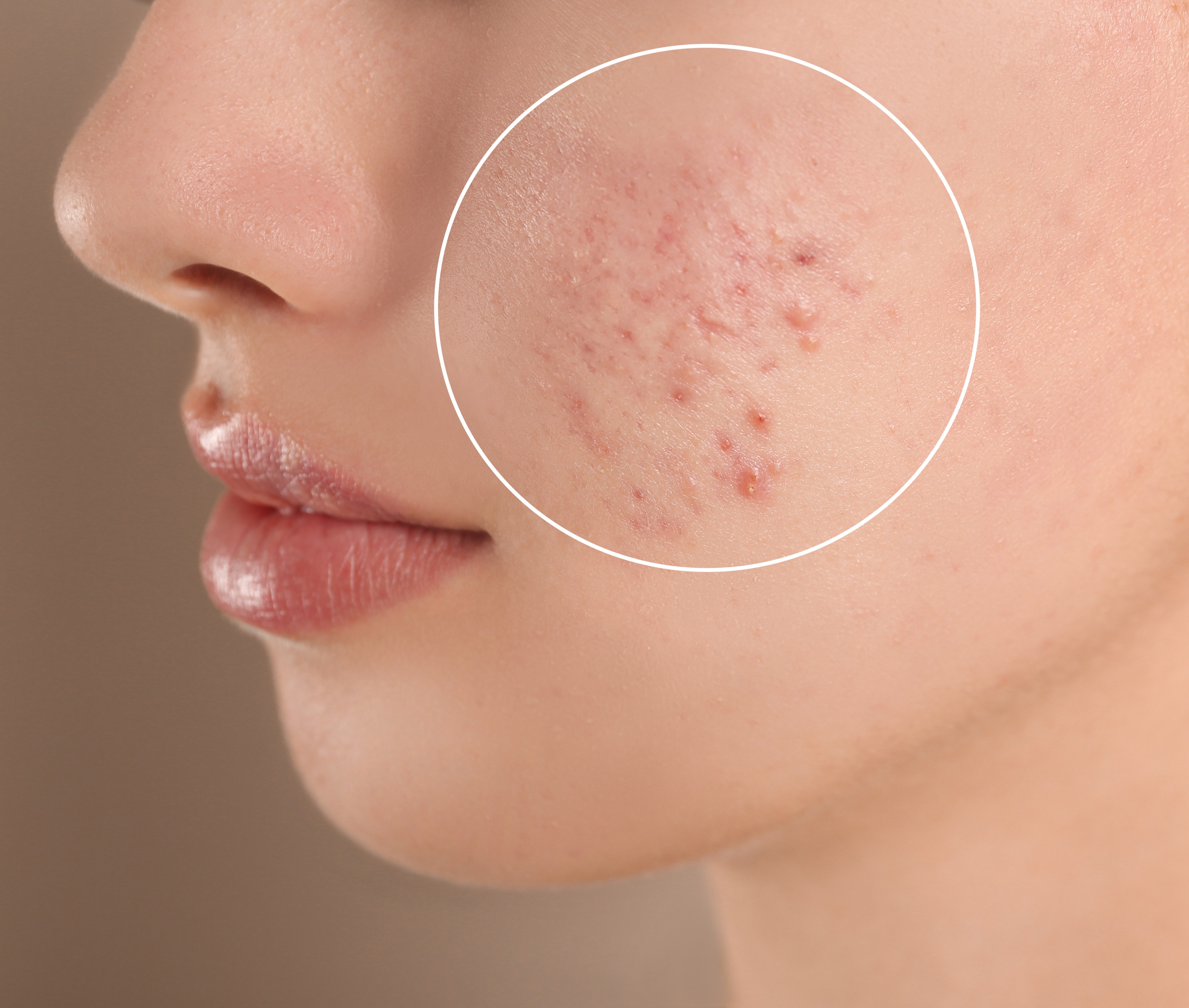 best acne treatment in hyderabad