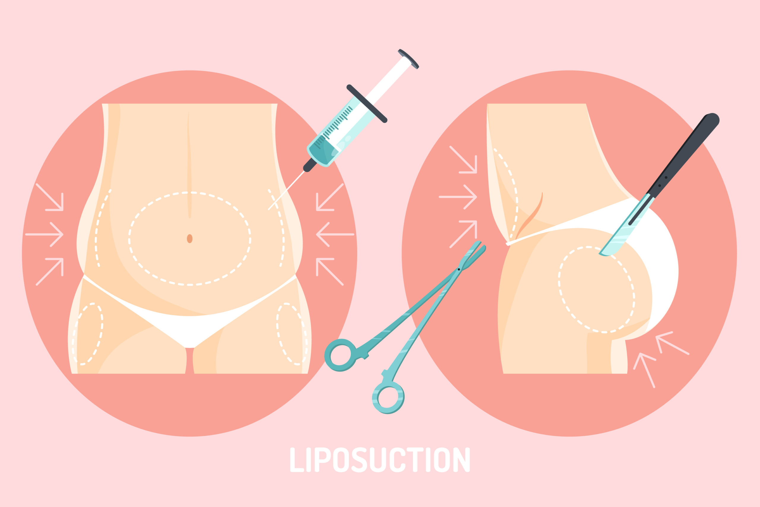 liposuction surgery in Hyderabad