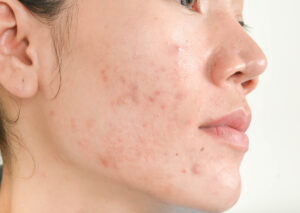 Best acne treatment in hyderabad