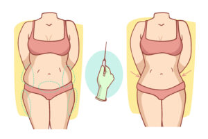 liposuction surgery in hyderabad
