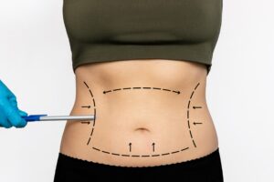 liposuction surgery in hyderabad