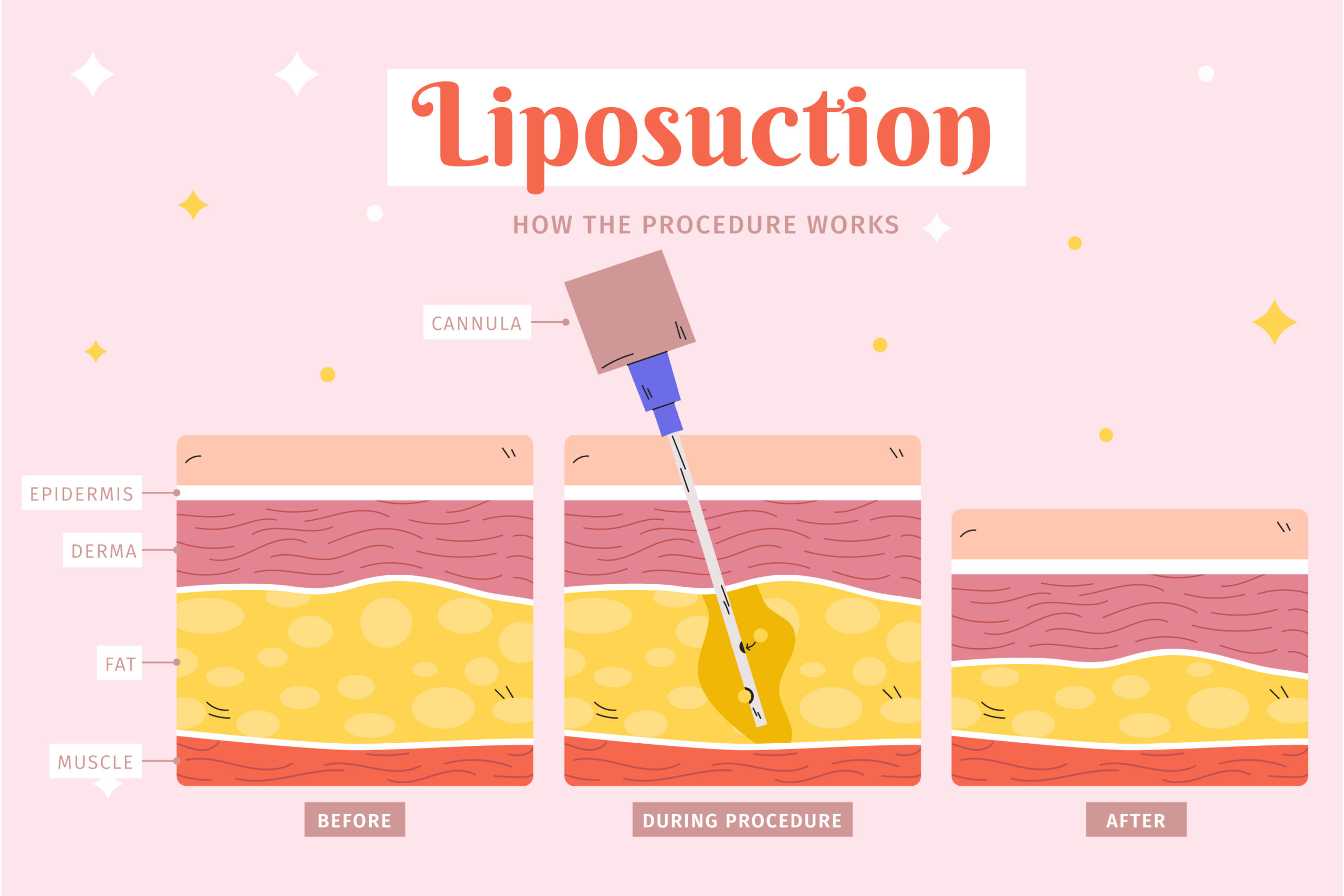 liposuction in hyderabad