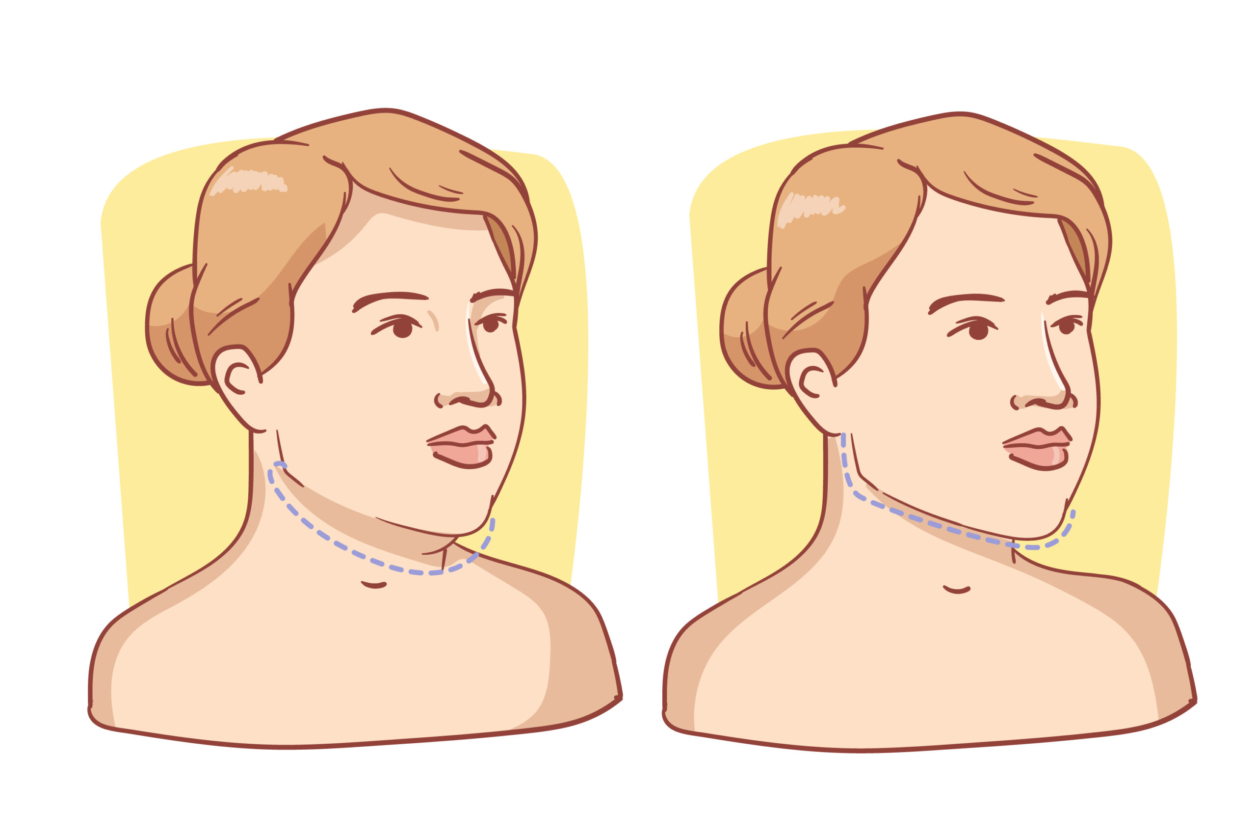 necklift surgery