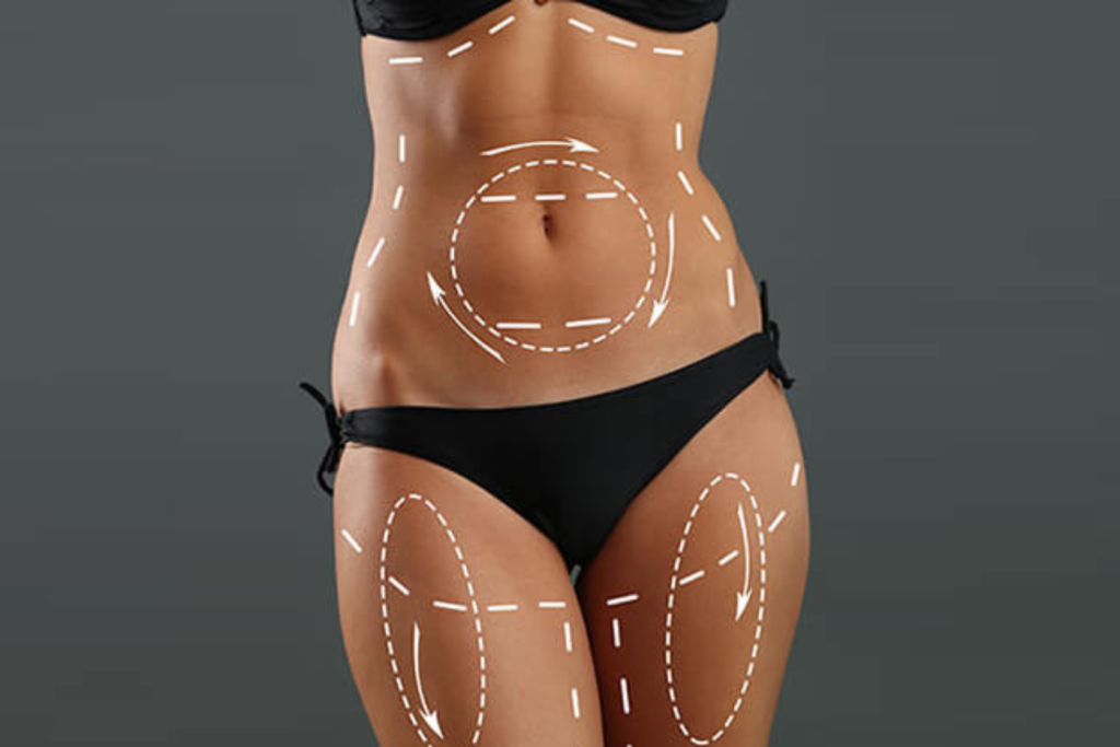 liposuction in hyderabad