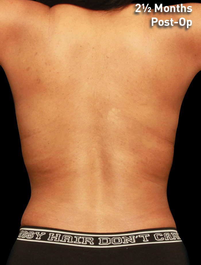 Body-and-Neck-BA-FOR-REVEAL-DUPLECHAIN-BACK-33YO-AFTER-2