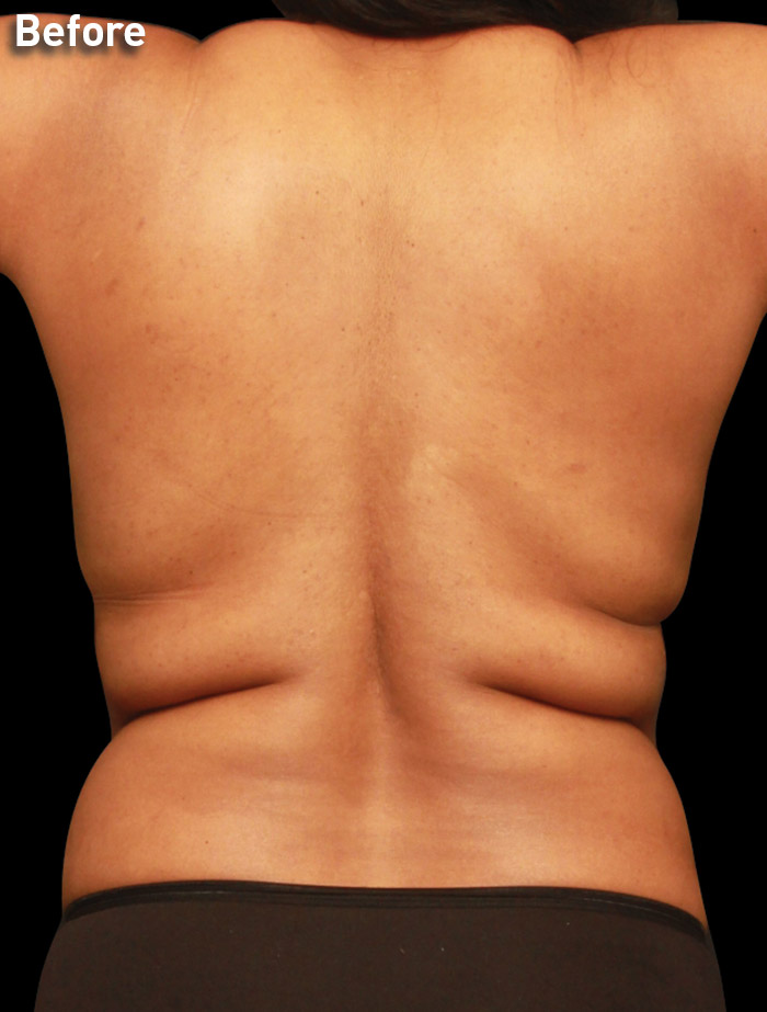 Body-and-Neck-BA-FOR-REVEAL-DUPLECHAIN-BACK-33YO-BEFORE