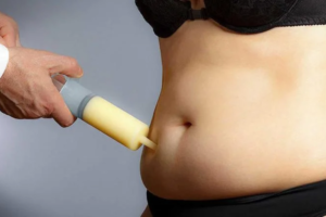 liposuction in Hyderabad