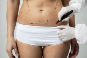 Best Liposuction in Hyderabad