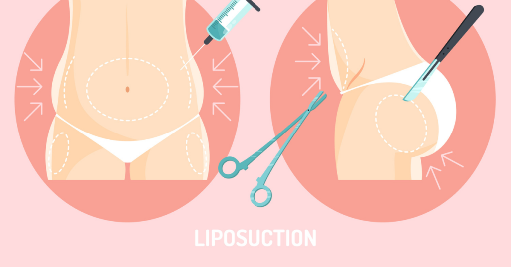 Best Liposuction in Hyderabad