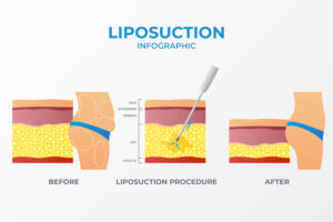best liposuction in Hyderabad