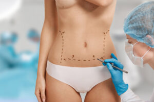 Cosmetic Surgery Liposuction in Hyderabad
