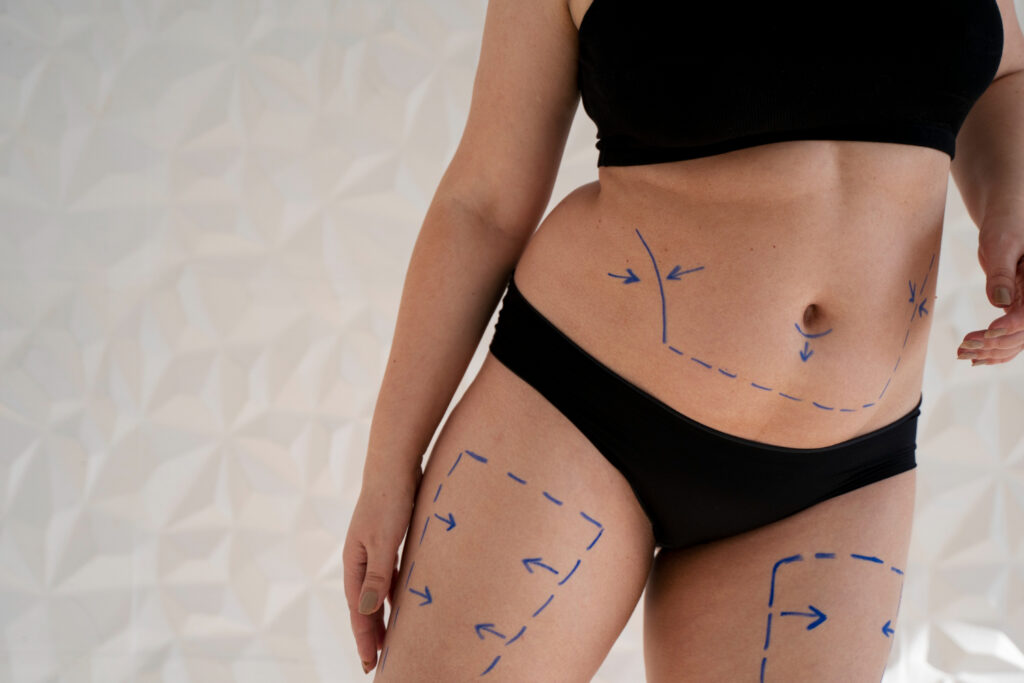 Cosmetic surgery liposuction in Hyderabad