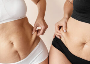 Non-surgical liposuction in Hyderabad