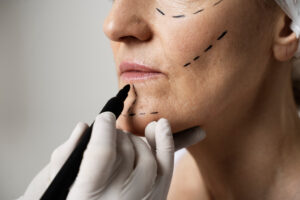 Best Facelift Treatment in Hyderabad