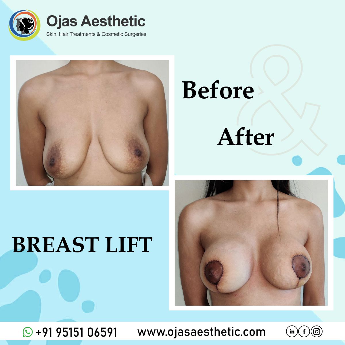 Before-AFTER-BREAST-LIFT1