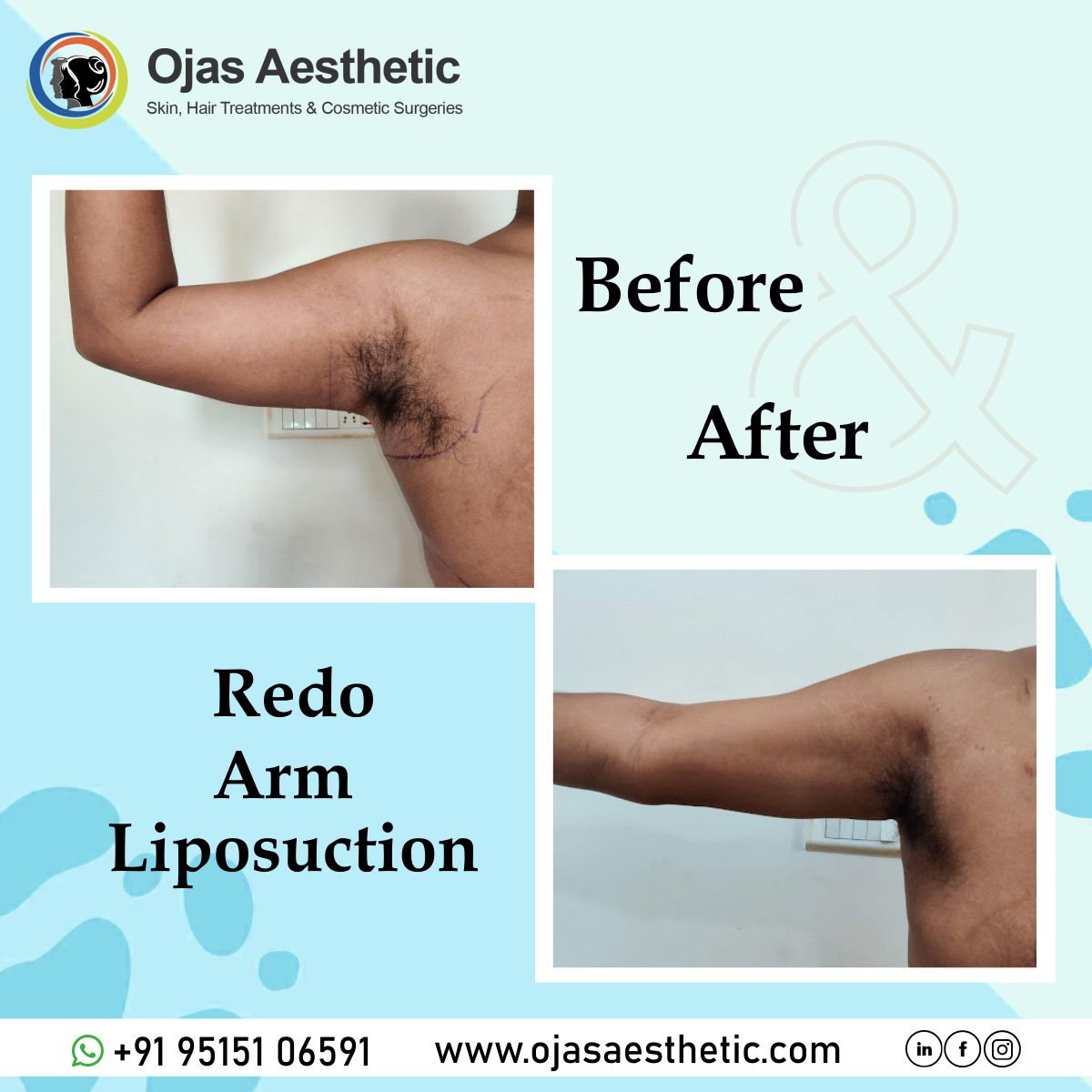 Before-AFTER-BREAST-LIFT10