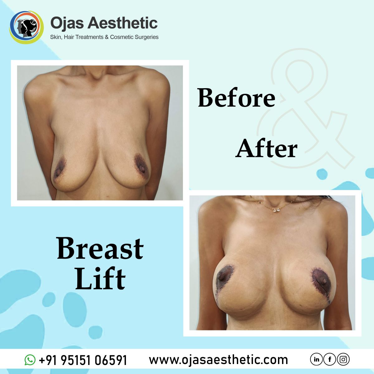 Before-AFTER-BREAST-LIFT15