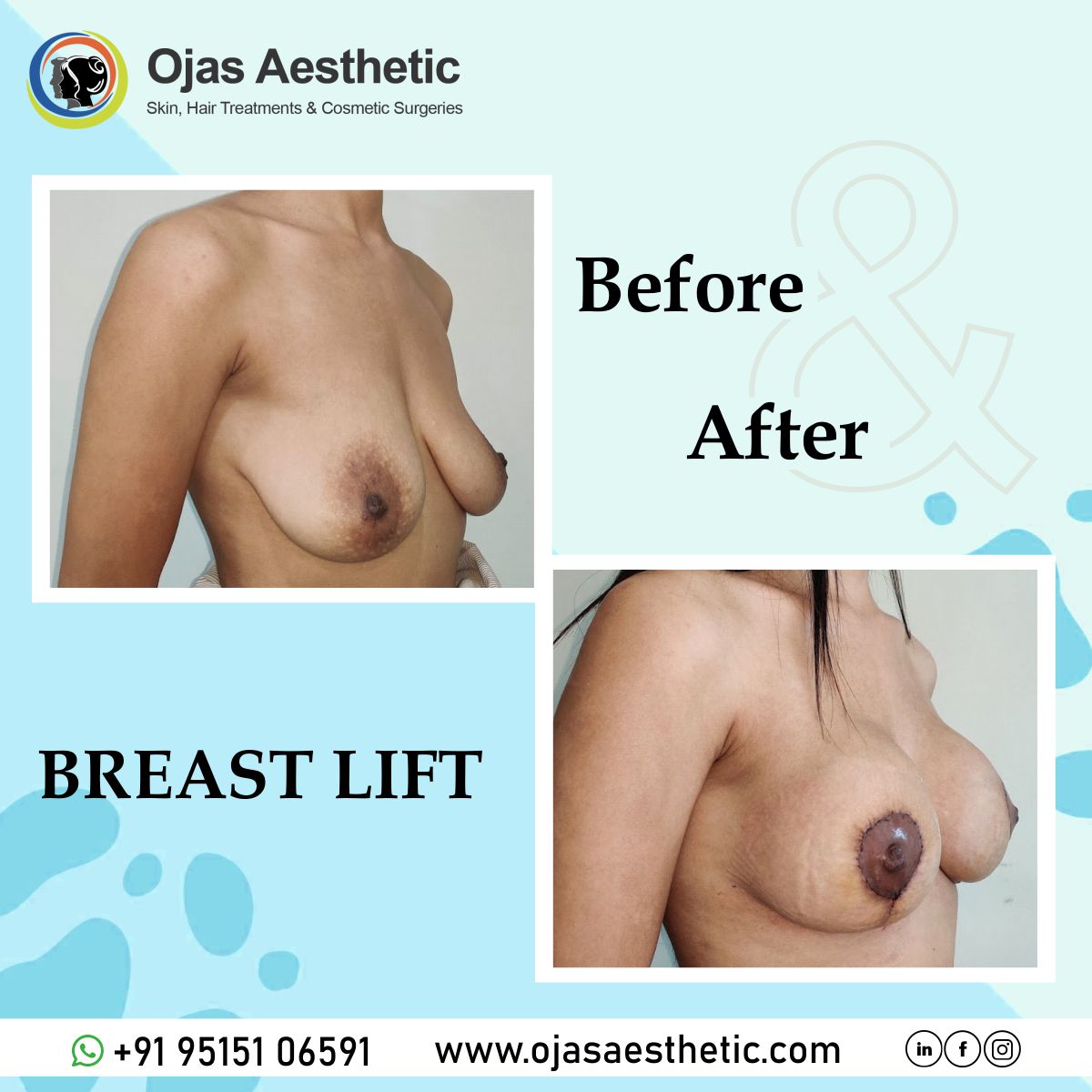Before-AFTER-BREAST-LIFT2