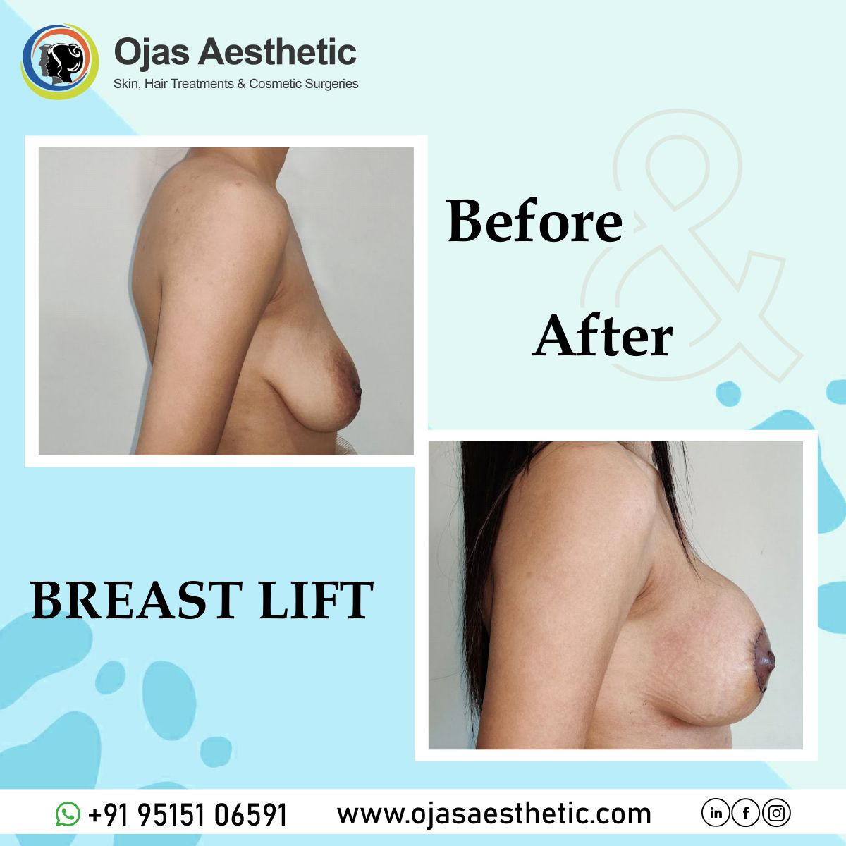 Before-AFTER-BREAST-LIFT3