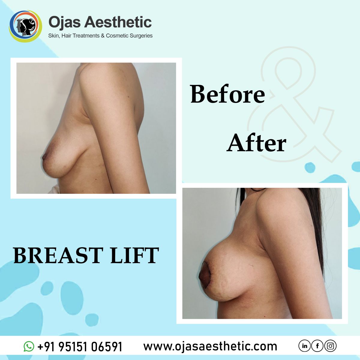 Before-AFTER-BREAST-LIFT4
