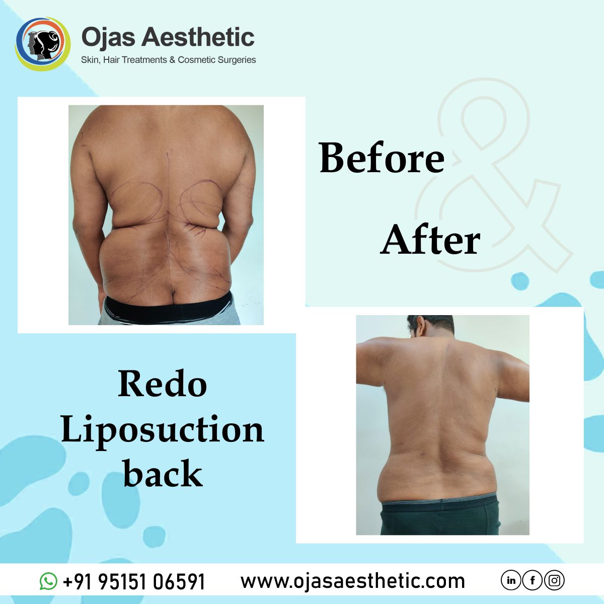 Before-AFTER-BREAST-LIFT8