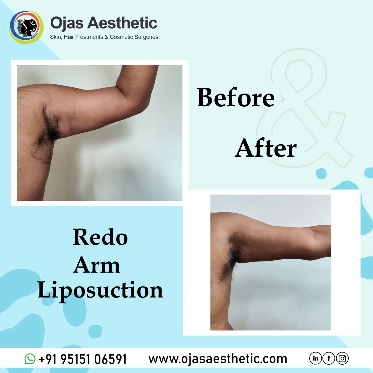 Before-AFTER-BREAST-LIFT9