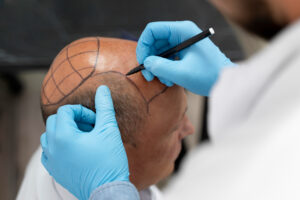 Hair Transplant in Hyderabad