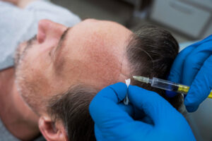 Hair Transplant in Hyderabad
